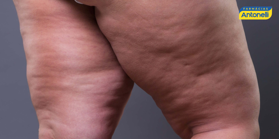 Diferença entre Lipedema, Obesidade e Linfedema